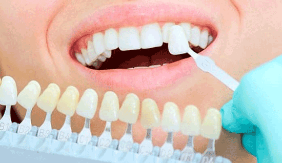 اصلاح طرح لبخند با کامپوزیت، برای چه دندان هایی مناسب است؟