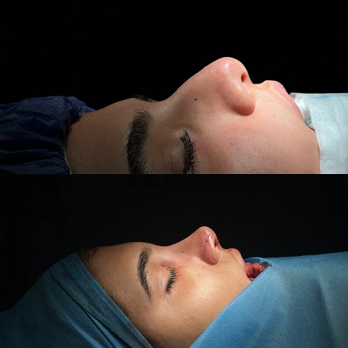 نمونه جراحی بینی طبیعی زنان