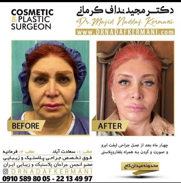 آیا لیفت شقیقه جای بخیه به جای می‌گذارد؟