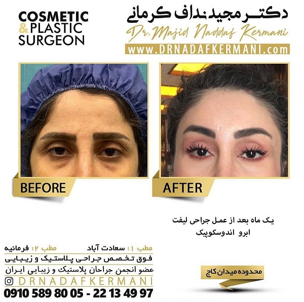 لیفت شقیقه چیست و چه روش‌هایی دارد؟ 