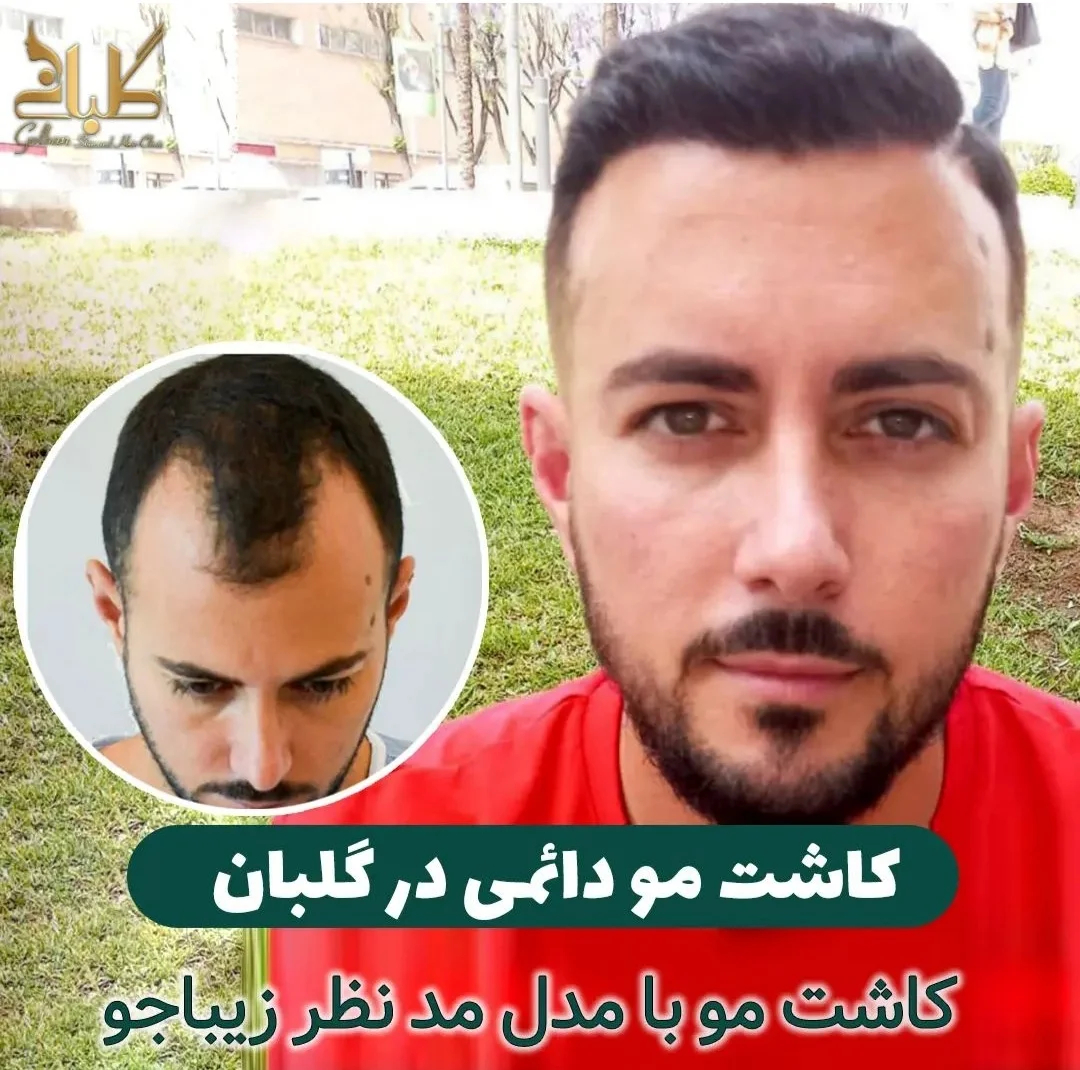 نمونه کاشت مو در کلینیک زیبایی گلبان