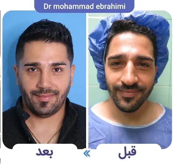 علت اصلی خوکی شدن بینی بعد از عمل