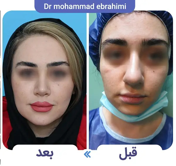 عوارض عمل بینی سر بالا