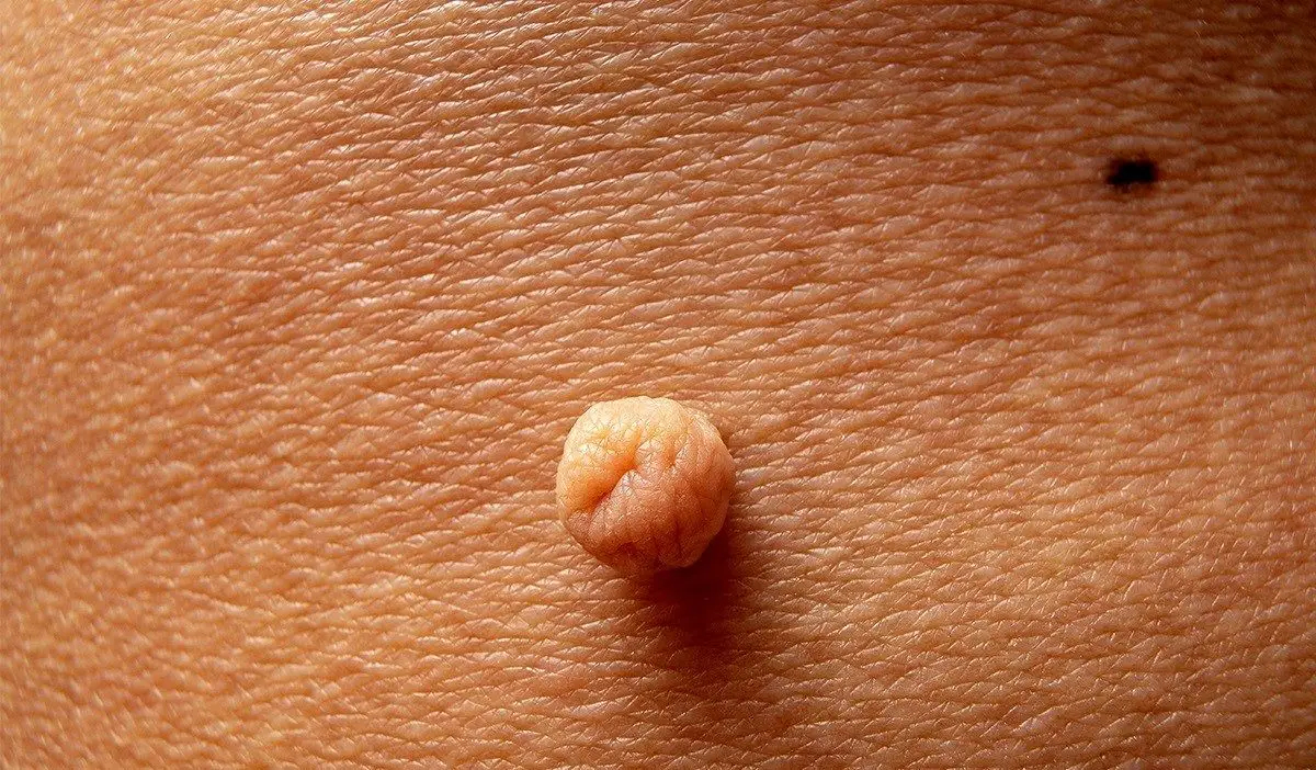 ویژگی های خال گوشتی
