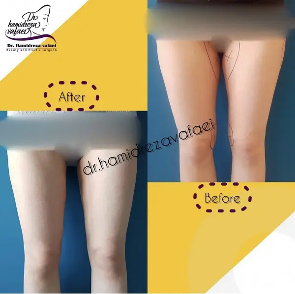 لاغری با پیکرتراشی؛ آیا این روند مشکل زا است؟ 