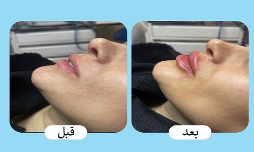 قیمت روز تزریق ژل لب در ۱۴۰۴؛ چقدر برای زیبایی لب‌ها باید هزینه کرد؟