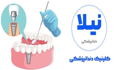 چرا تقاضای ایمپلنت دندان در تهران و کرج سر به فلک کشید؟ نیاز فوری به مراکز تخصصی شبانه‌روزی!