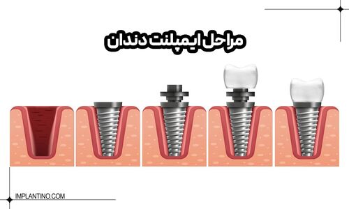 همه چیز درباره مراحل ایمپلنت دندان که باید حتما بدانید!