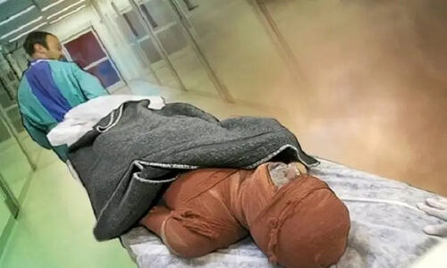 آمار تکان‌دهنده سوختگی در ایران؛ سالانه ۳۰۰ هزار قربانی و هشدار جدی ایمنی!