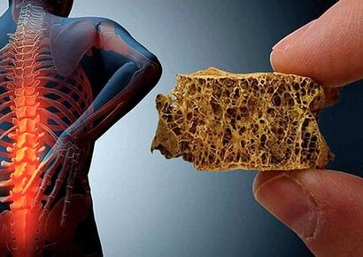 راهکاری طلایی جلوگیری از پوکی استخوان چیست؟