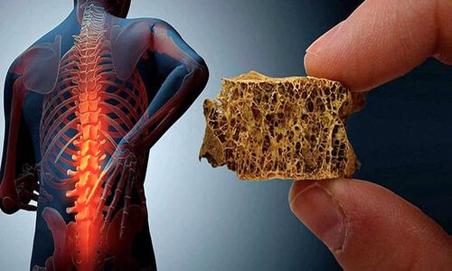 راهکاری طلایی جلوگیری از پوکی استخوان چیست؟